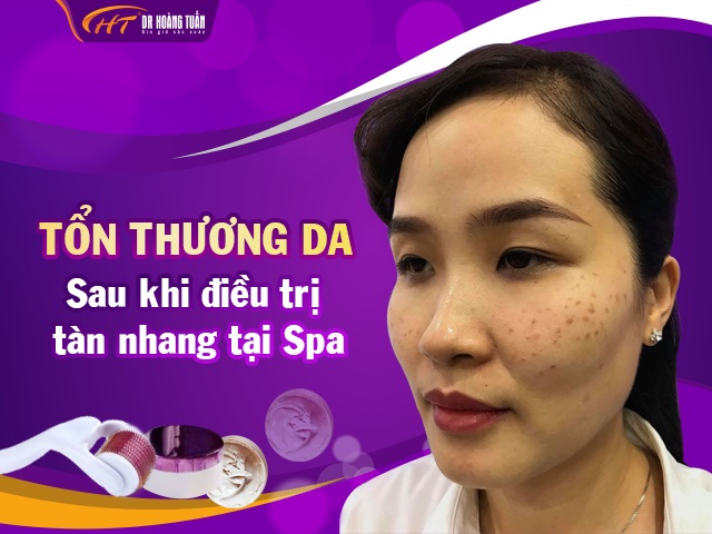 Tổn thương da sau khi điều trị tàn nhang tại spa